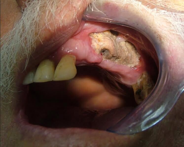 טיפולי שיניים חולים אונקולוגים