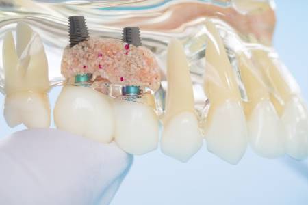 השתלות שיניים - רופאת שיניים מומחית