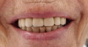 סיפור מקרה – טיפול שיניים מורכב ללא הפסקה בטיפול תרופתי