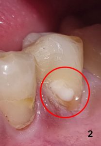 המשך טיפול סתימה לבנה במרפאת שיניים בכרמיאל