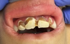 נערה בת 14 עם בעיות בשיניים