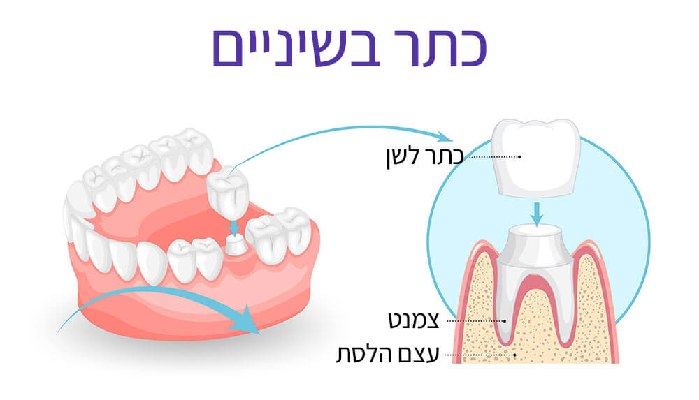 אילוסטרציה של כתר בשיניים